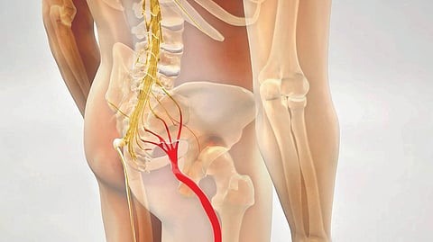 Sciatica Pain