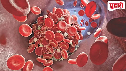Dengue Symptoms