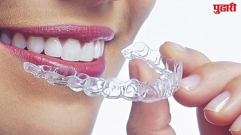 Invisalign Aligners