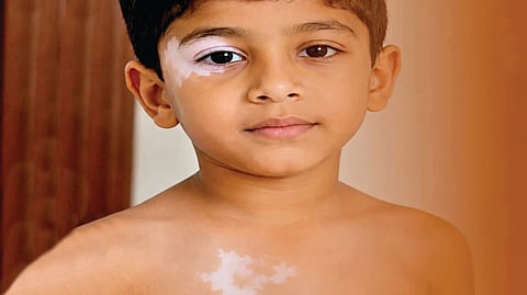 Vitiligo Treatment | 
