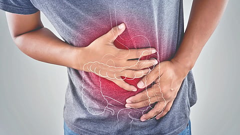 Colon Cancer |