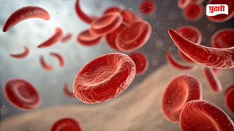 Sickle Cell Disease