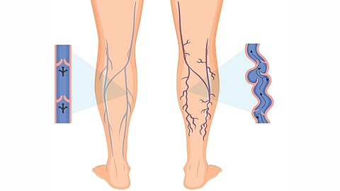 Calf Muscle Disorder |