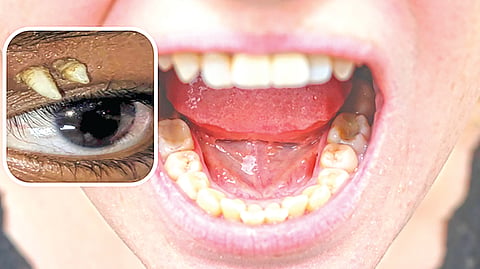 Teeth Over Eyes |