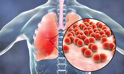 Hospital-Acquired Pneumonia | 