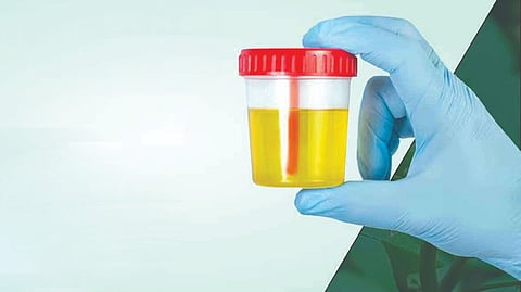 Kidney Disease Symptoms |
