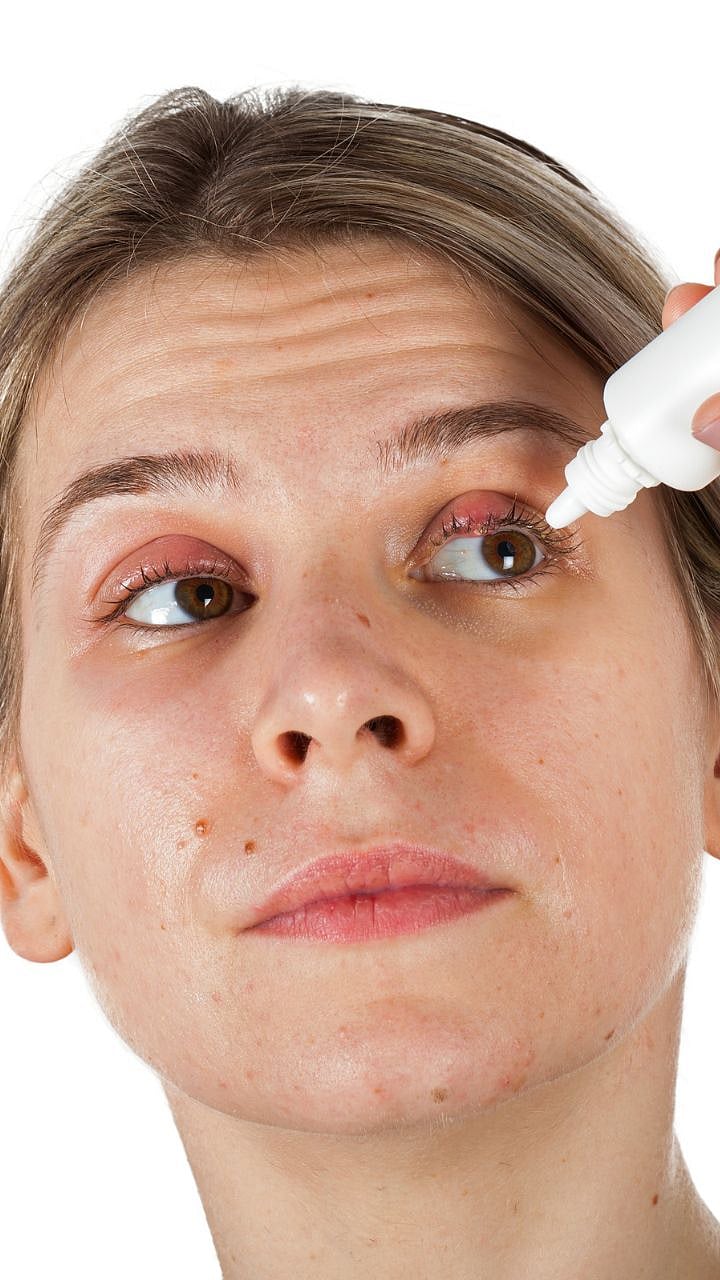 Eye disease| डोळ्यांवर सतत रांजणवाडी येतेय? जाणून घ्या यामागची कारणे