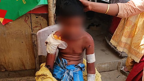 Delhi Boy Mauled By Dogs