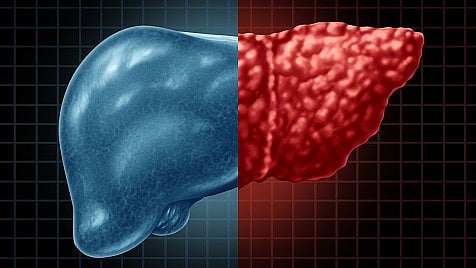 Fatty liver disease 