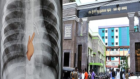 எல்இடி பல்ப்-பை விழுங்கிய குழந்தைக்கு  நுரையீரல் அகநோக்கி சிகிச்சை