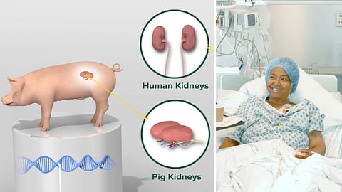 Albama woman who received Pig Organ Transplant