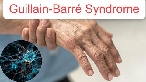Guillain Barre Syndrome