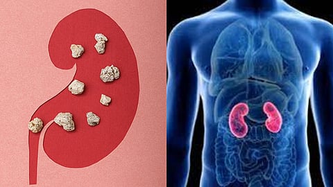 kidney stones