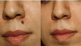 DIY mole removal is dangerous