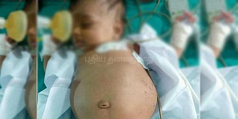 3 மாத குழந்தையின் வயிற்றுக்குள் மற்றொரு குழந்தை: மருத்துவர்கள் அதிர்ச்சி