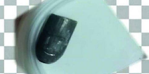 2 ஆண்டுகளாக முதுகுவலி; அறுவை சிகிச்சையில் சிக்கிய துப்பாக்கிக் குண்டு