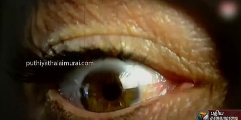 கருப்புப் பூஞ்சை நோயின் அறிகுறிகள் என்ன? - நோய் எதிர்ப்பு சக்தி குறைவானவர்கள் எச்சரிக்கை
