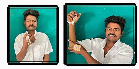 இளைஞரின் துண்டான உள்ளங்கை மீண்டும் வெற்றிகரமாக பொருத்தம்: கோவை அரசு மருத்துவமனை சாதனை