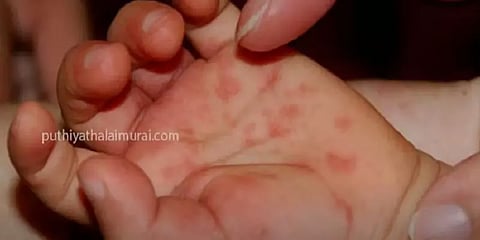 தக்காளி காய்ச்சலால் பாதிக்கப்படும் குழந்தைகள் - கேரளாவில் பரவும் புதிய வகை வைரஸ் காய்ச்சல்