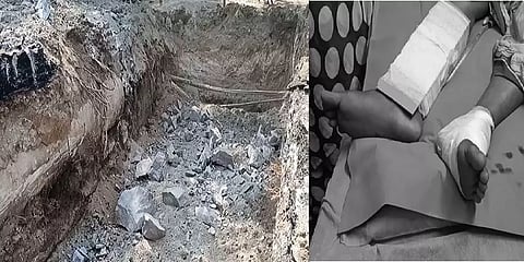 அனுமதியின்றி சாலையில் வைக்கப்பட்ட வெடி... பெண் கூலித்தொழிலாளிக்கு 2 கால்களிலும் பாதிப்பு
