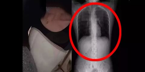 இருமுனதுக்கே  எலும்பு முறிவா? - காரமான உணவை சாப்பிட்ட சீனப்பெண்ணுக்கு நடந்த சோகம்