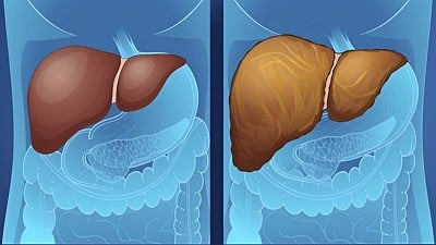 Fatty Liver பாதிப்பும் விழிப்புணர்வும்.. கல்லீரலைப் பாதுகாக்க உதவும் ‘டாப்’ குறிப்புகள்!