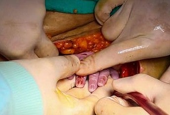 آپریشن سے بچے کی پیدائش ’ایک عالمی بیماری‘