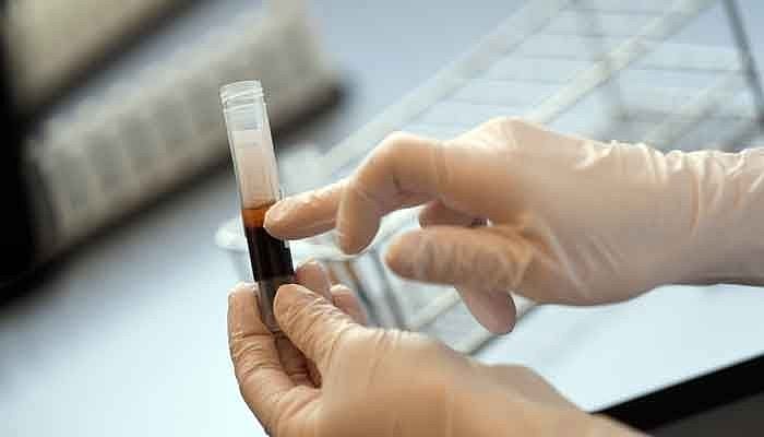 حیدرآباد: گاندھی اسپتال میں پیر سے پلازمہ تھراپی کے ذریعہ ہوگا علاج