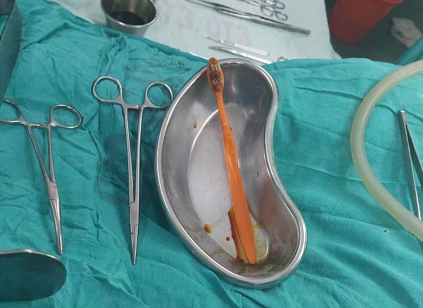 مسلم ڈاکٹر کا کمال، کامیاب آپریشن کر پیٹ سے نکالا 9 انچ لمبا ٹوتھ برش