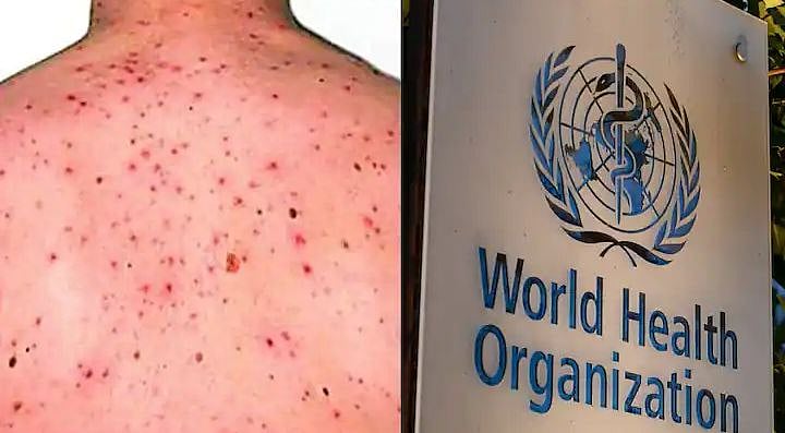 کینیا میں ’ایم پاکس‘ کے کیسز میں اضافہ، محکمہ صحت کی ایڈوائزری جاری