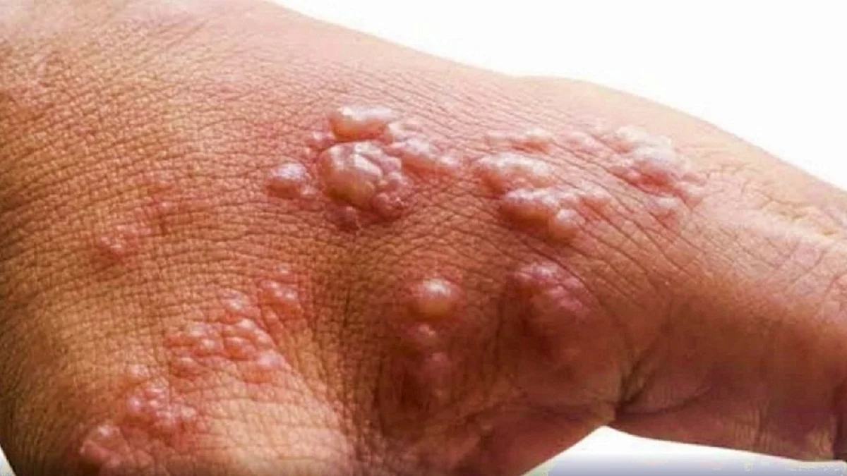 منکی پاکس، تصویر آئی اے این ایس