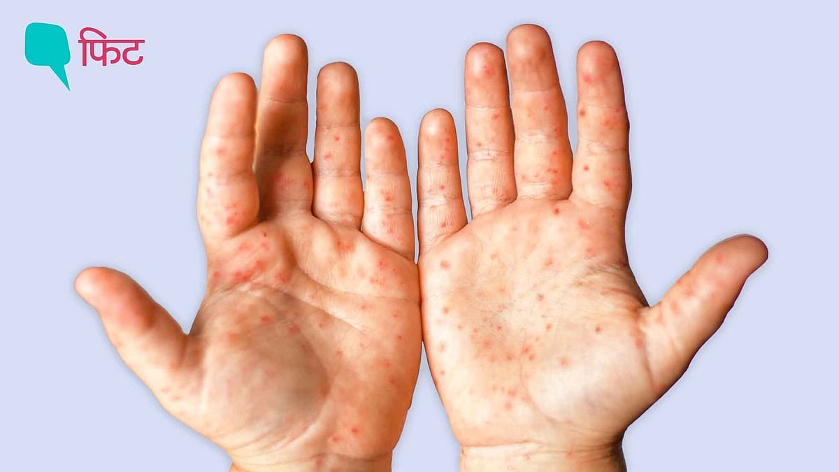 <div class="paragraphs"><p>Measles Outbreak In India: WHO ने कहा कि भारत में अब तक कम से कम 9489 मामलों का पता चला है</p></div>