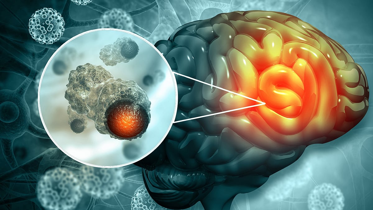 <div class="paragraphs"><p>World Brain Tumor Day 2023: ब्रेन ट्यूमर के रोगी में ऊर्जा की कमी हो जाती है.</p></div>