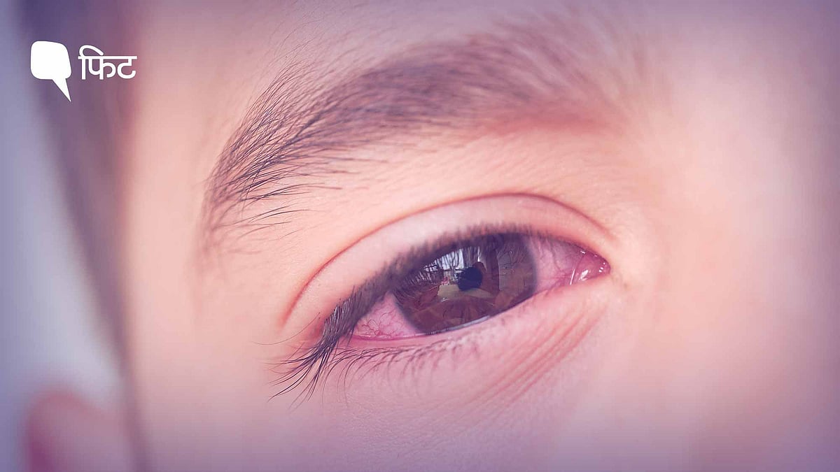 <div class="paragraphs"><p><strong>Conjunctivitis Prevention:&nbsp;</strong>कंजंक्टिवाइटिस के लक्षण और  बचाव के उपाय क्या हैं?</p></div>