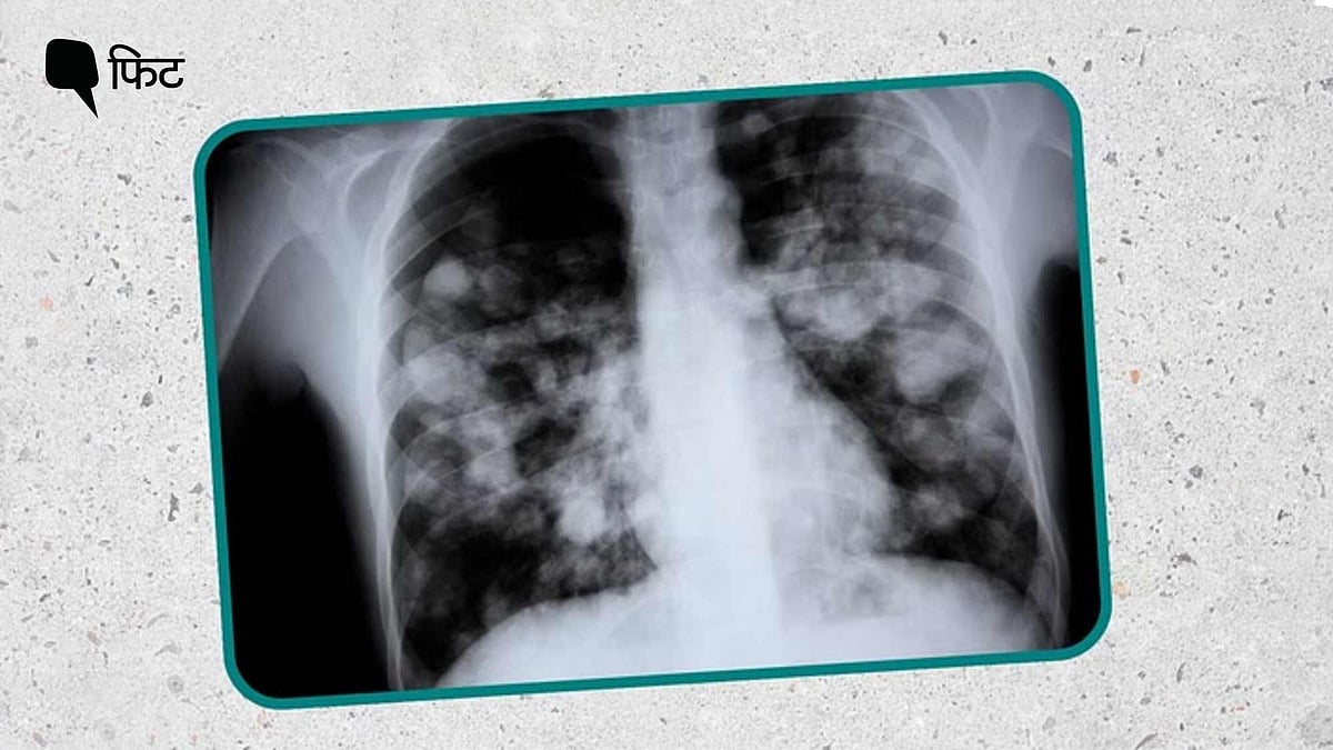 <div class="paragraphs"><p><strong>White Lung Syndrome</strong> या एक्यूट रेस्पिरेटरी डिस्ट्रेस सिंड्रोम बेहद गंभीर और खतरनाक कंडीशन है.</p></div>