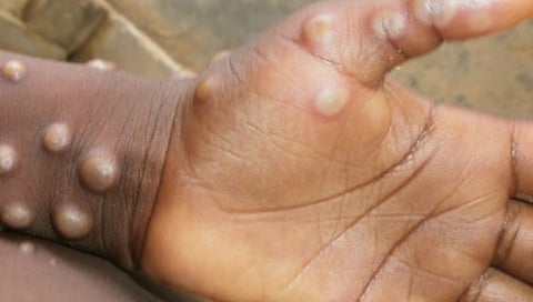 कोरोनानंतर आता देशात Monkeypox चा धोका; जाणून घ्या लक्षणे  