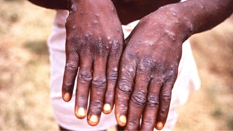 Monkeypox