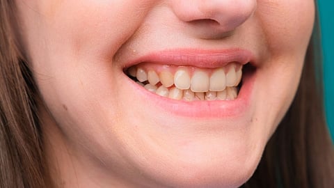 Tips to Get Rid of Yellow Teeth