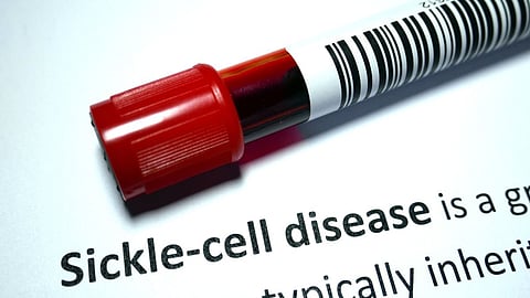 World sickle cell day 2022 