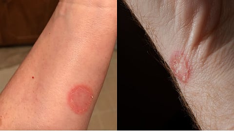 Ringworm 