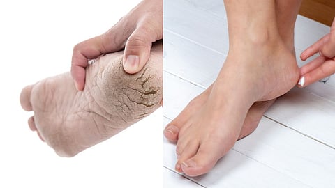 Winter Foot Care