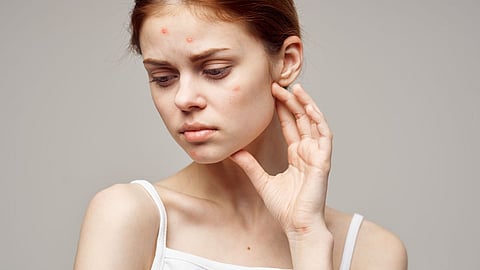 Teenagers Skin Care 