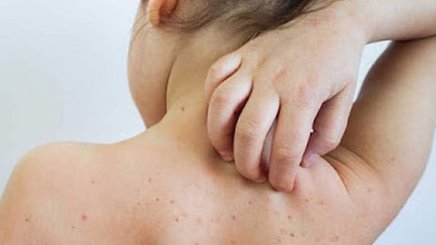 Measles Disease