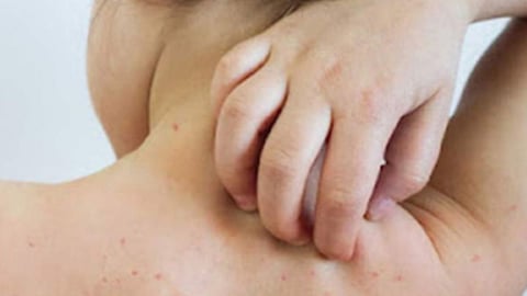 Measles 