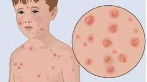Measles Disease