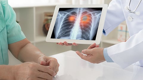 Lungs Cancer 