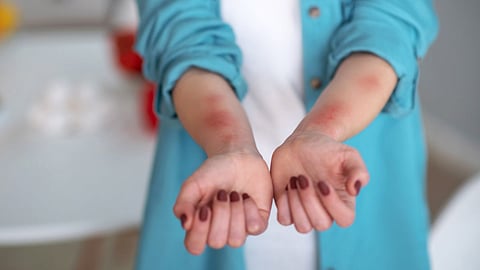 Urticaria 