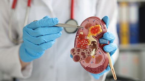Kidney Stone 
