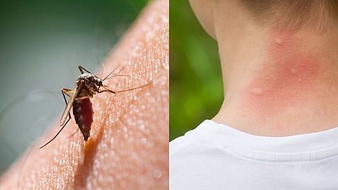 Place Swell After A Mosquito Bite