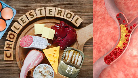 Bad Cholesterol 